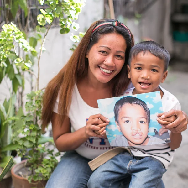 globe telecom - smile train - cleft lip and palate - patient